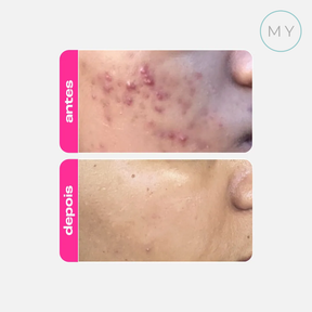 Ácido Mandélico Gel Clareador Antiacne 30g - Creamy